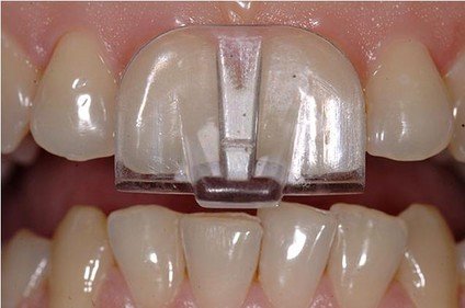 Bekwaam Vierde ledematen NTI-TSS splint helpt tegen tandenknarsen, bestel hier online